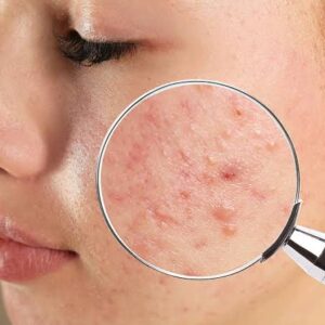 Acne Treatments