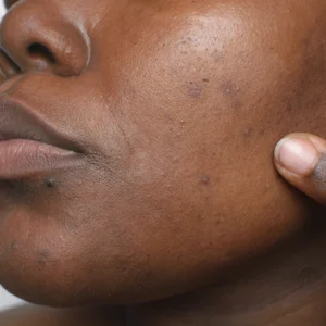 Brightening /Hyperpigmentation